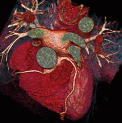 immagini di TAC al cuore